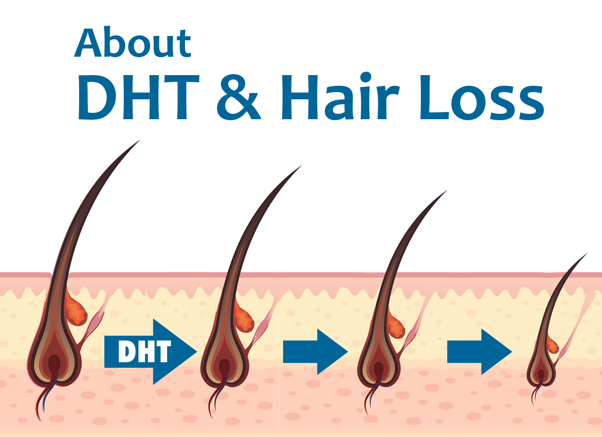 薄毛の敵DHTを抑制しよう