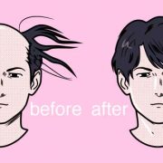 薄毛対策！生活習慣の改善と驚異の内服育毛薬「フィナロイド」で必ず生える！